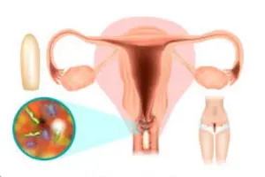 Genital Infections Treatment